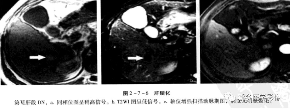 肝硬化磁共振影像表现 肝硬化磁共振影像表现