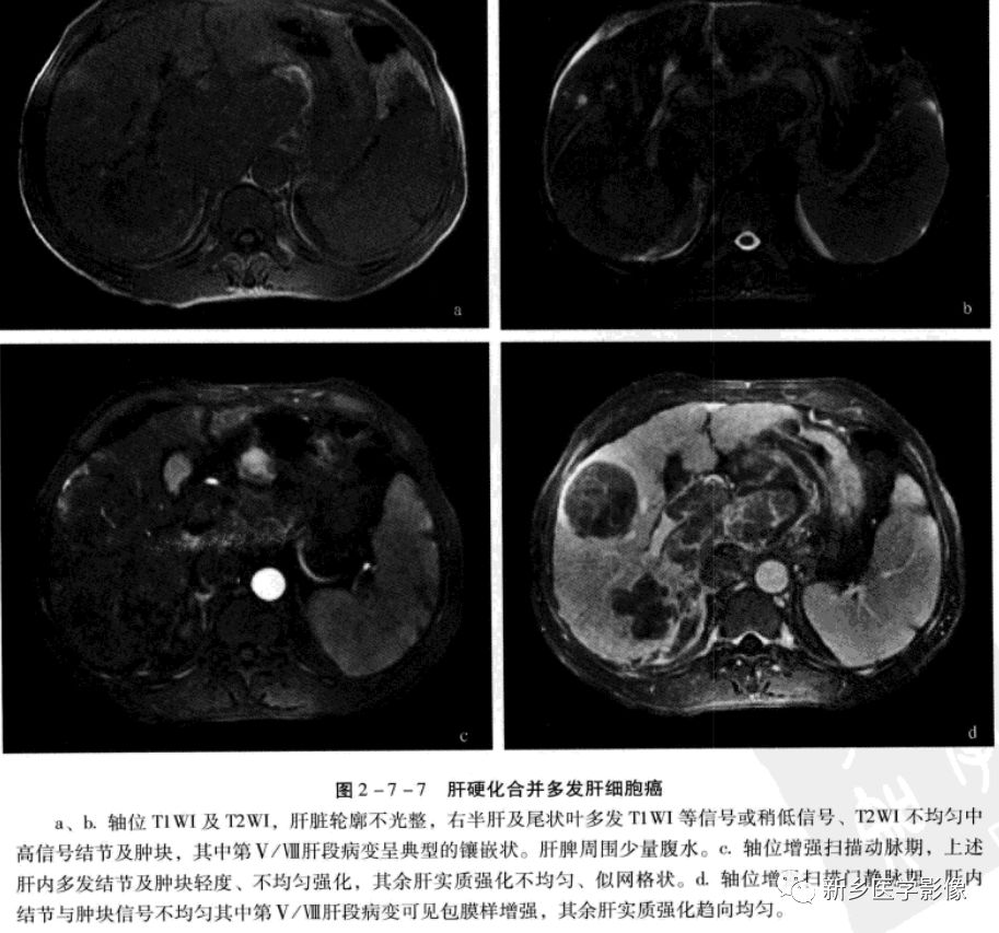 肝硬化磁共振影像表现 肝硬化磁共振影像表现