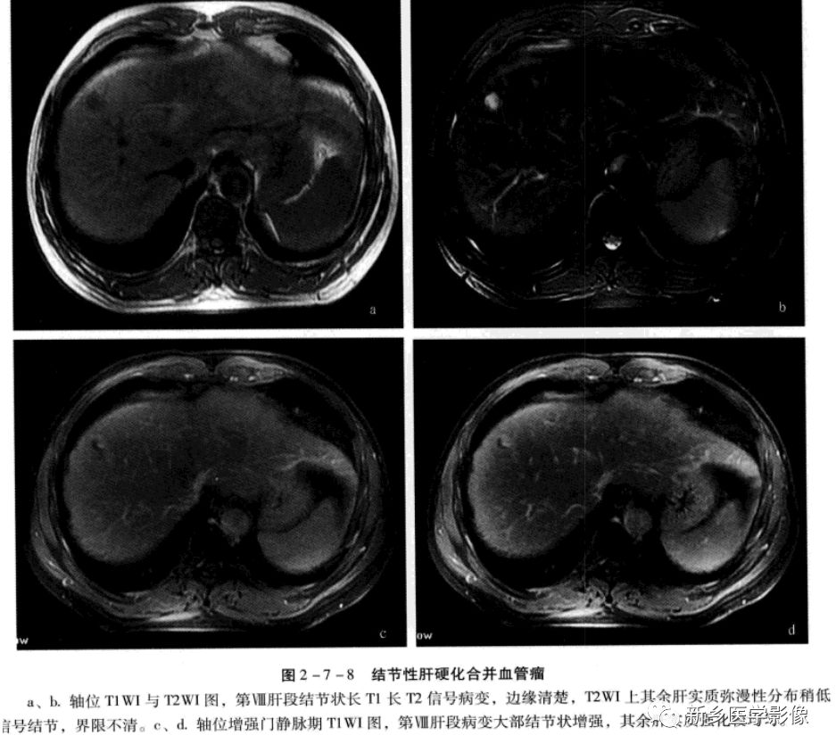 肝硬化磁共振影像表现 肝硬化磁共振影像表现