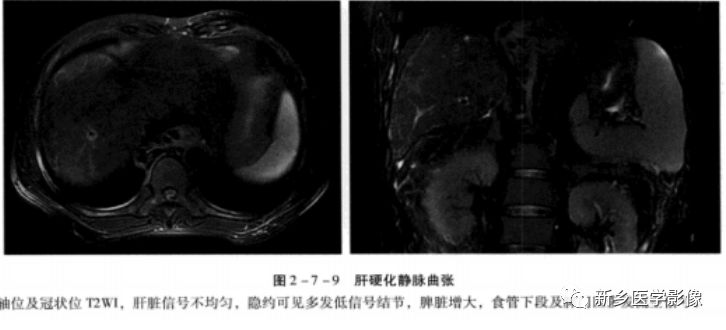 肝硬化磁共振影像表现 肝硬化磁共振影像表现