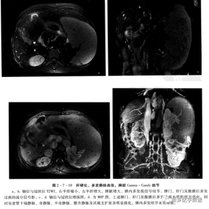 肝硬化磁共振影像表现 肝硬化磁共振影像表现