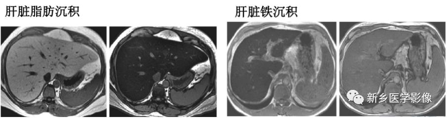 肝脏铁过度沉积