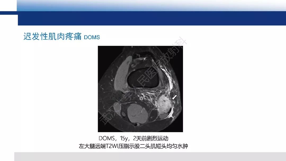 【PPT】肌肉创伤MR诊断：解剖、生物力学、病理生理学及影像学表现