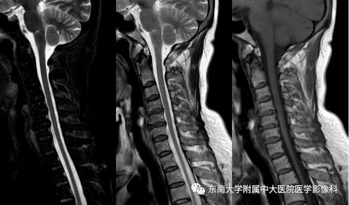 【病例】硬脊膜动静脉瘘1例MR影像诊断