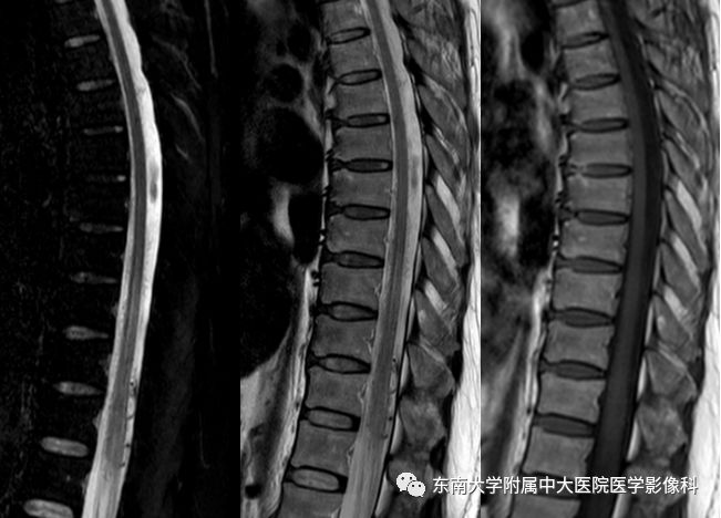 【病例】硬脊膜动静脉瘘1例MR影像诊断
