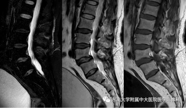 【病例】硬脊膜动静脉瘘1例MR影像诊断