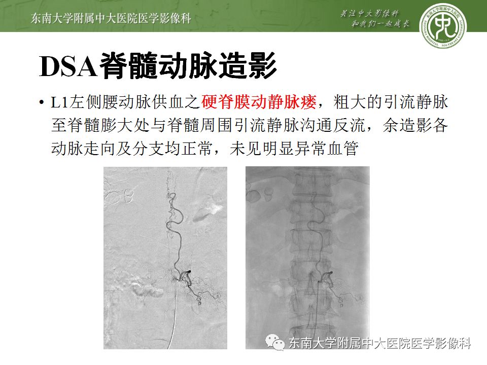 【病例】硬脊膜动静脉瘘1例MR影像诊断