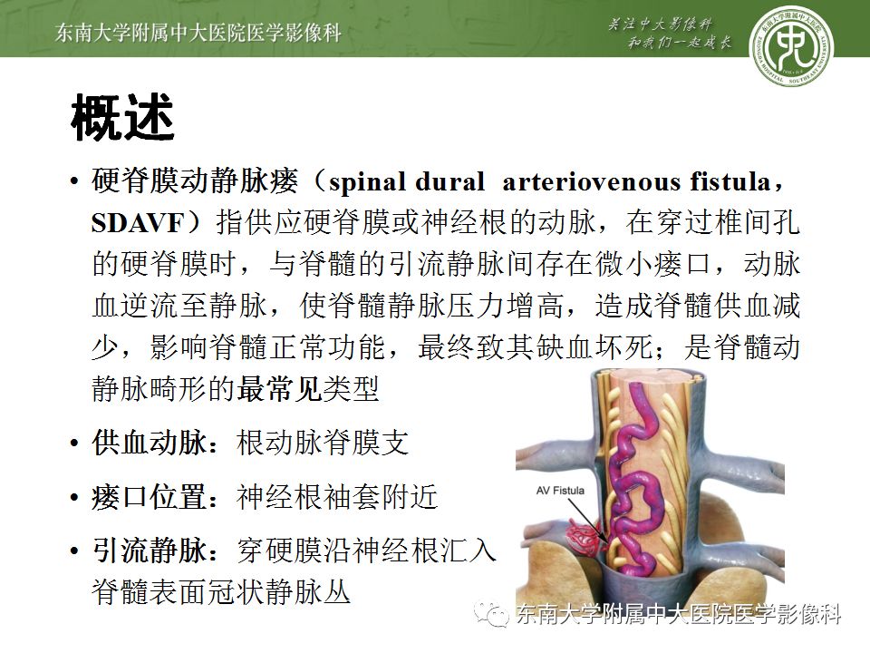 【病例】硬脊膜动静脉瘘1例MR影像诊断