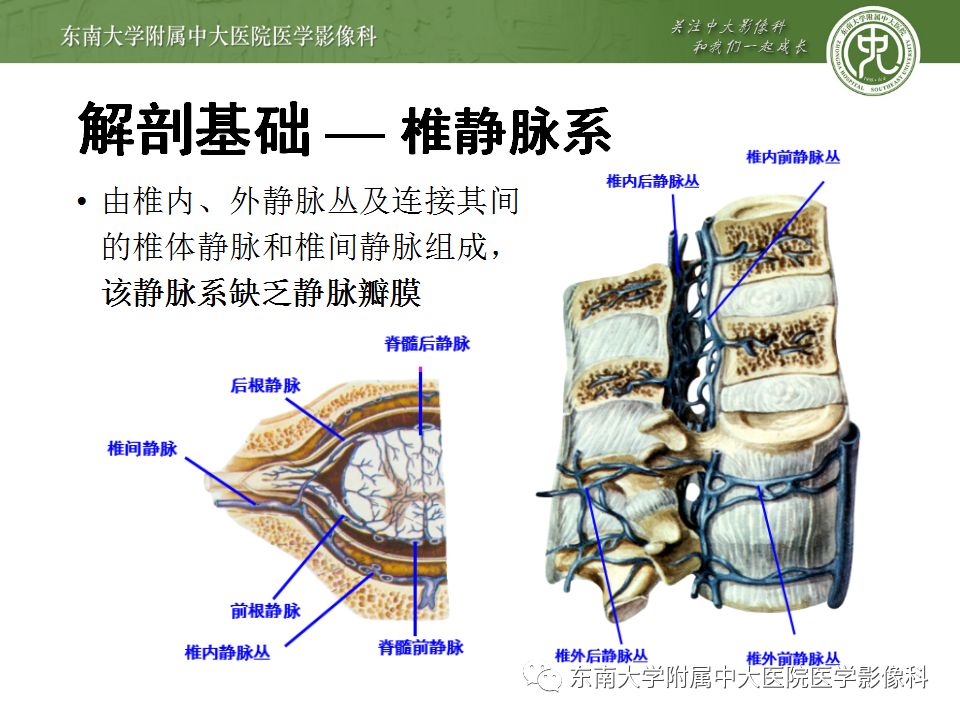 【病例】硬脊膜动静脉瘘1例MR影像诊断