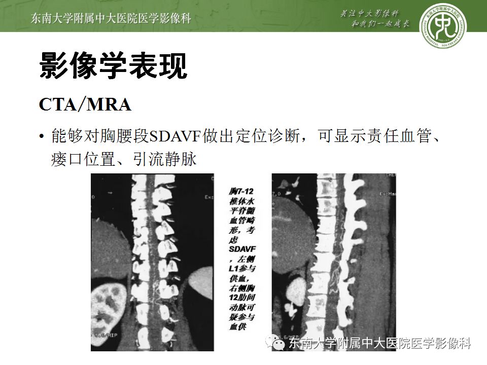 【病例】硬脊膜动静脉瘘1例MR影像诊断