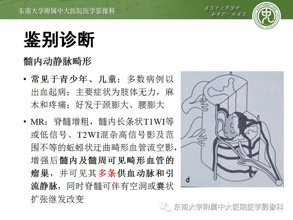 【病例】硬脊膜动静脉瘘1例MR影像诊断