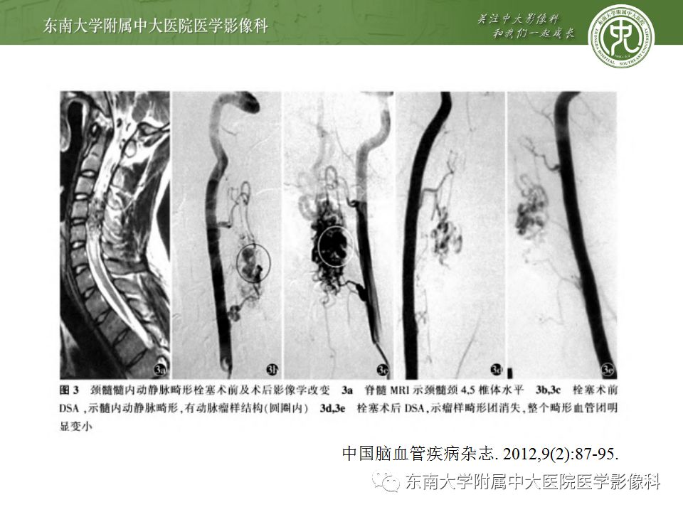 【病例】硬脊膜动静脉瘘1例MR影像诊断