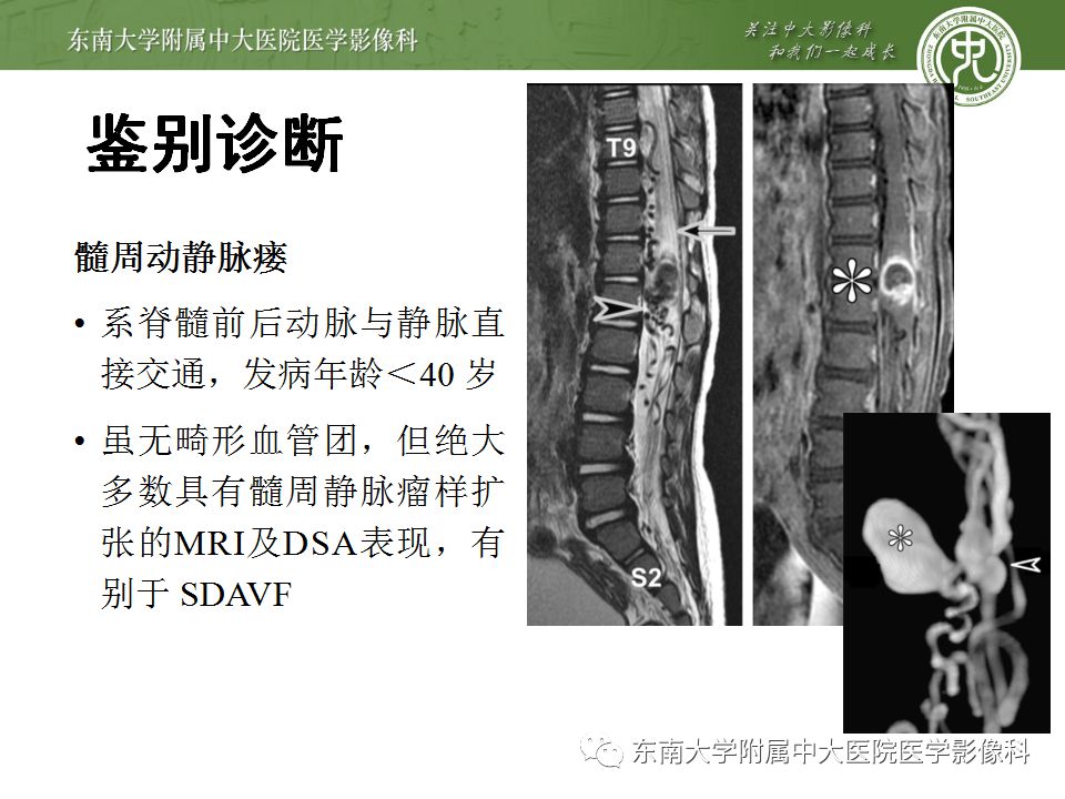 【病例】硬脊膜动静脉瘘1例MR影像诊断