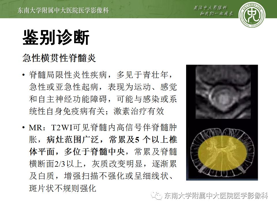 【病例】硬脊膜动静脉瘘1例MR影像诊断