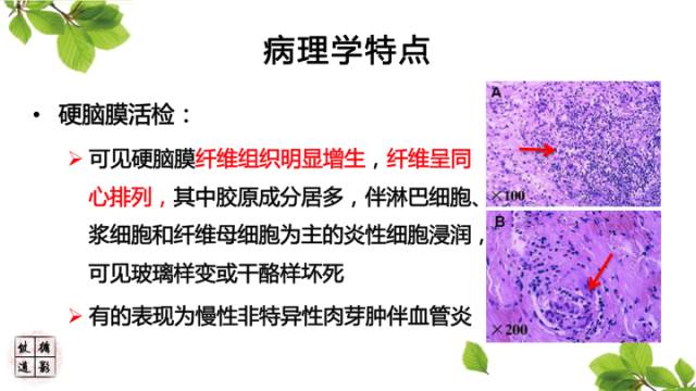 【病例】肥厚性硬脑膜炎1例MR影像表现