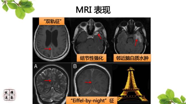 【病例】肥厚性硬脑膜炎1例MR影像表现