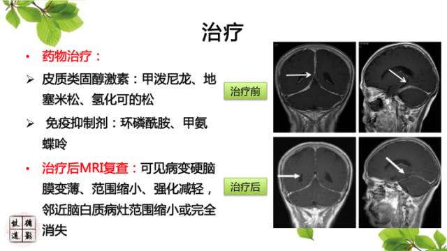 【病例】肥厚性硬脑膜炎1例MR影像表现