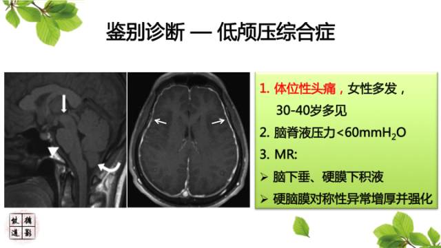 【病例】肥厚性硬脑膜炎1例MR影像表现
