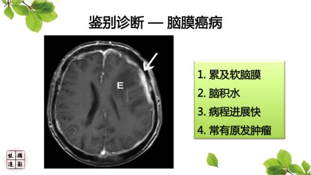 【病例】肥厚性硬脑膜炎1例MR影像表现