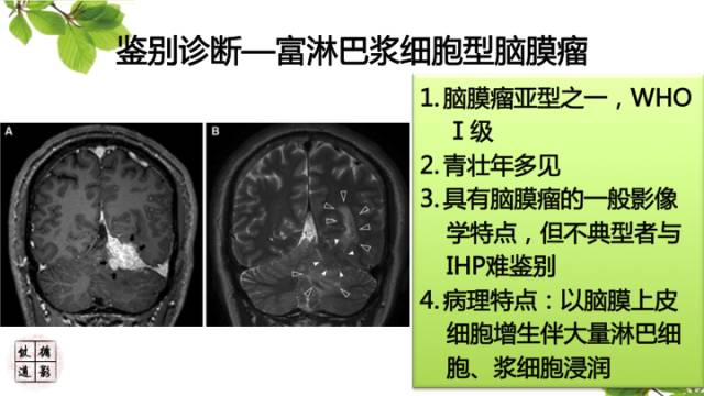 【病例】肥厚性硬脑膜炎1例MR影像表现