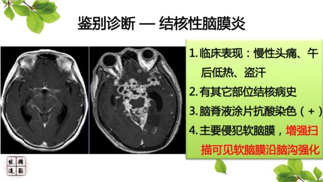 【病例】肥厚性硬脑膜炎1例MR影像表现