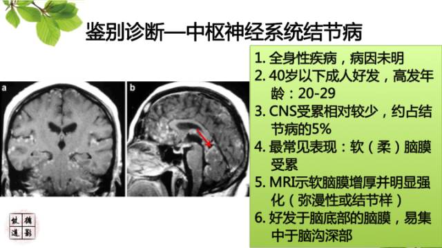 【病例】肥厚性硬脑膜炎1例MR影像表现