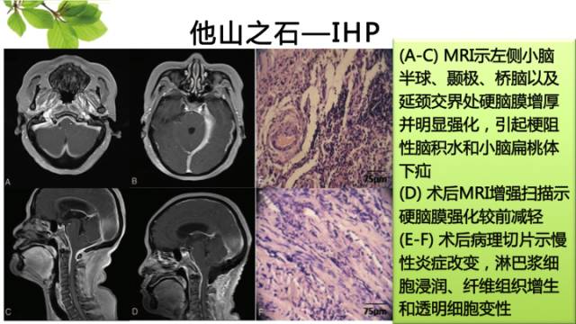 【病例】肥厚性硬脑膜炎1例MR影像表现