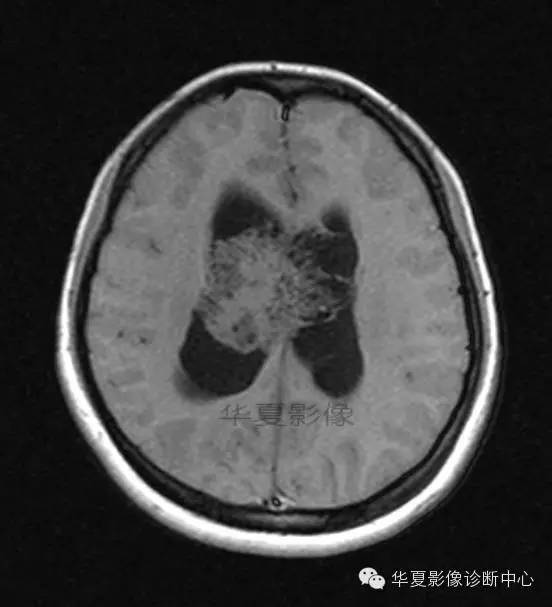 【病例】室管膜瘤? 中枢神经细胞瘤 ? 【病例】室管膜瘤? 中枢神经细胞瘤 ?