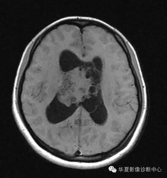 【病例】室管膜瘤? 中枢神经细胞瘤 ? 【病例】室管膜瘤? 中枢神经细胞瘤 ?