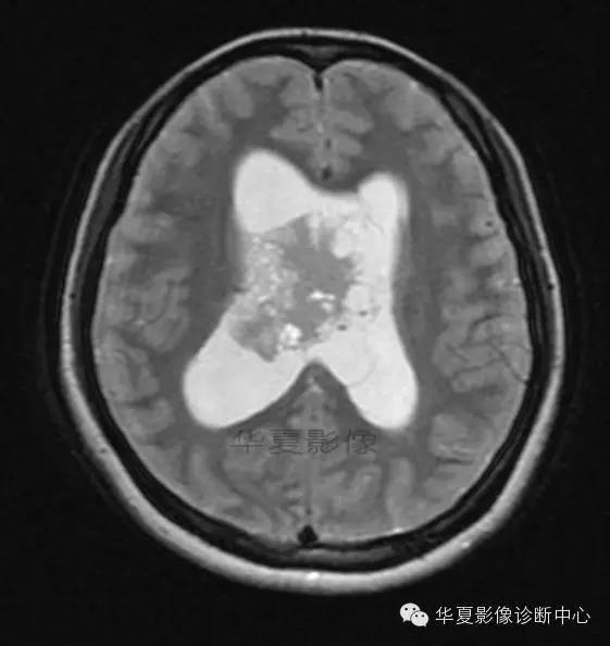 【病例】室管膜瘤? 中枢神经细胞瘤 ? 【病例】室管膜瘤? 中枢神经细胞瘤 ?