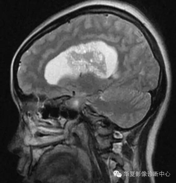 【病例】室管膜瘤? 中枢神经细胞瘤 ? 【病例】室管膜瘤? 中枢神经细胞瘤 ?