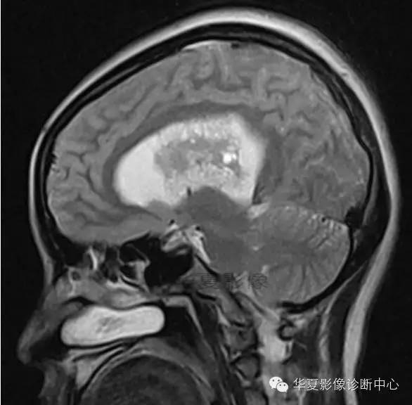 【病例】室管膜瘤? 中枢神经细胞瘤 ? 【病例】室管膜瘤? 中枢神经细胞瘤 ?