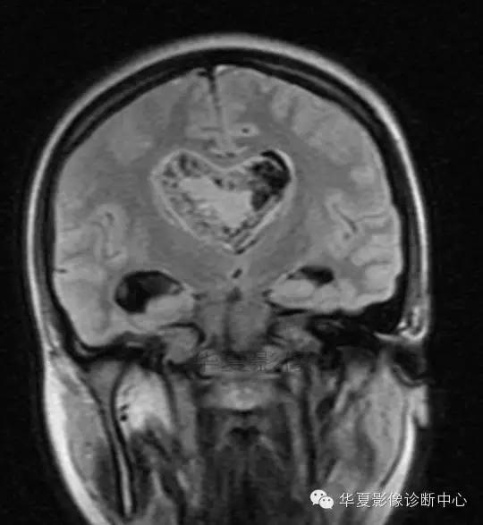 【病例】室管膜瘤? 中枢神经细胞瘤 ? 【病例】室管膜瘤? 中枢神经细胞瘤 ?