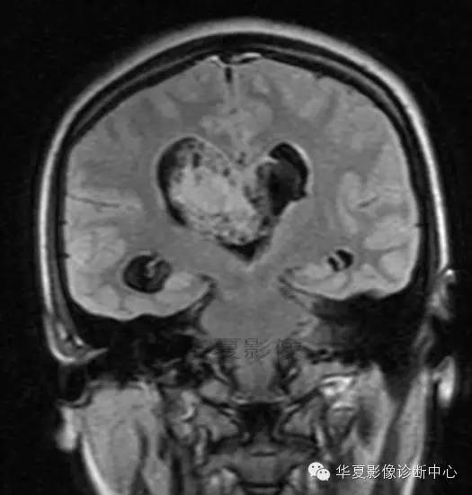 【病例】室管膜瘤? 中枢神经细胞瘤 ? 【病例】室管膜瘤? 中枢神经细胞瘤 ?