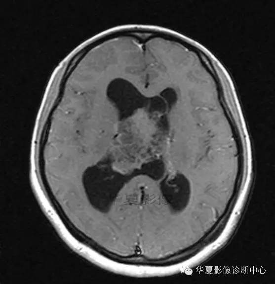 【病例】室管膜瘤? 中枢神经细胞瘤 ? 【病例】室管膜瘤? 中枢神经细胞瘤 ?