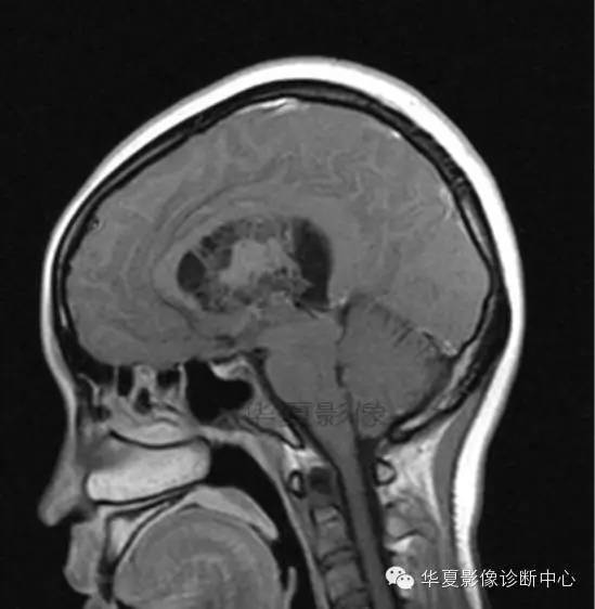 【病例】室管膜瘤? 中枢神经细胞瘤 ? 【病例】室管膜瘤? 中枢神经细胞瘤 ?