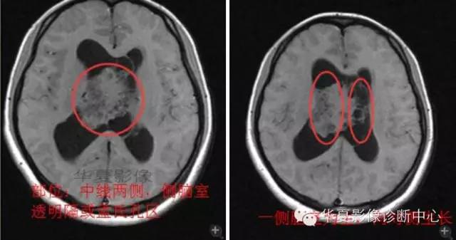 【病例】室管膜瘤? 中枢神经细胞瘤 ? 【病例】室管膜瘤? 中枢神经细胞瘤 ?