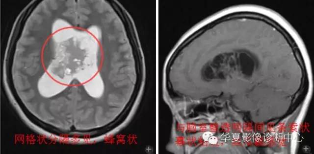 【病例】室管膜瘤? 中枢神经细胞瘤 ? 【病例】室管膜瘤? 中枢神经细胞瘤 ?