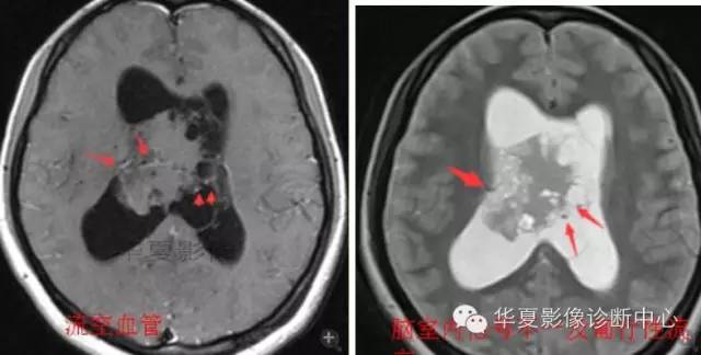 【病例】室管膜瘤? 中枢神经细胞瘤 ? 【病例】室管膜瘤? 中枢神经细胞瘤 ?
