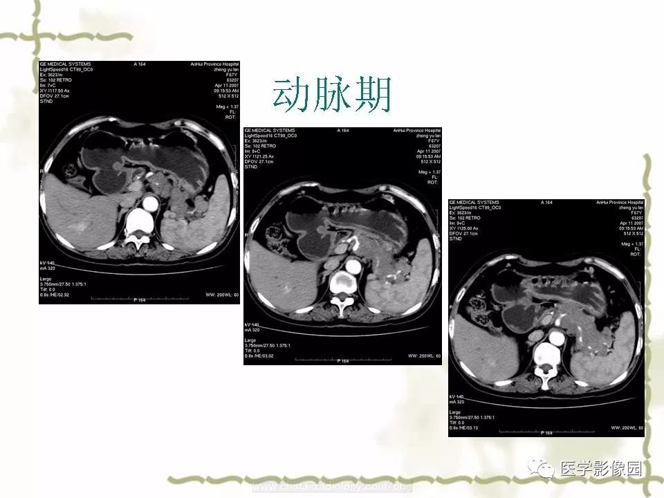 【病例】胰腺神经内分泌癌1例CT影像表现
