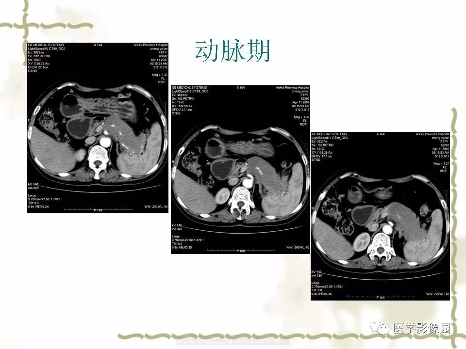 【病例】胰腺神经内分泌癌1例CT影像表现