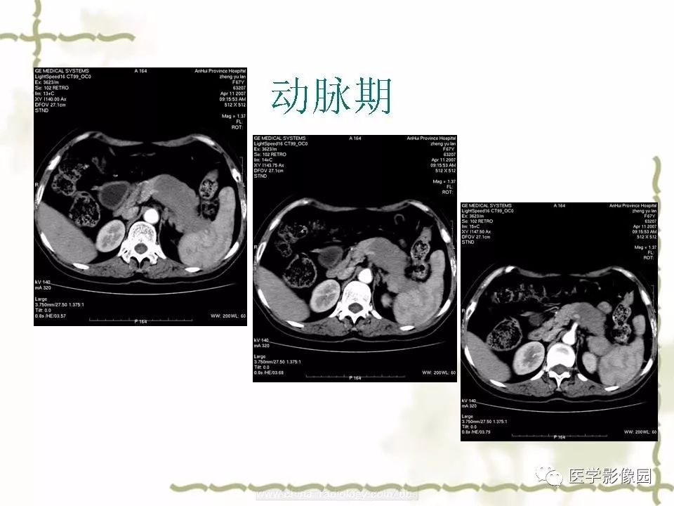 【病例】胰腺神经内分泌癌1例CT影像表现