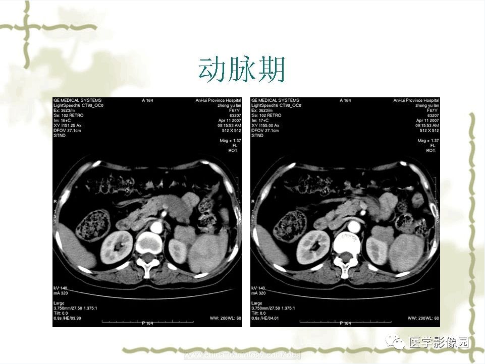 【病例】胰腺神经内分泌癌1例CT影像表现