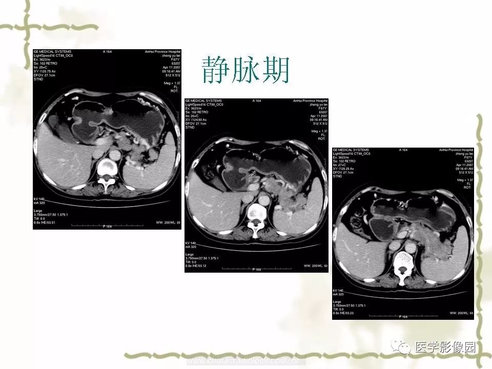 【病例】胰腺神经内分泌癌1例CT影像表现