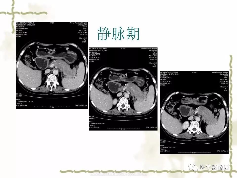 【病例】胰腺神经内分泌癌1例CT影像表现