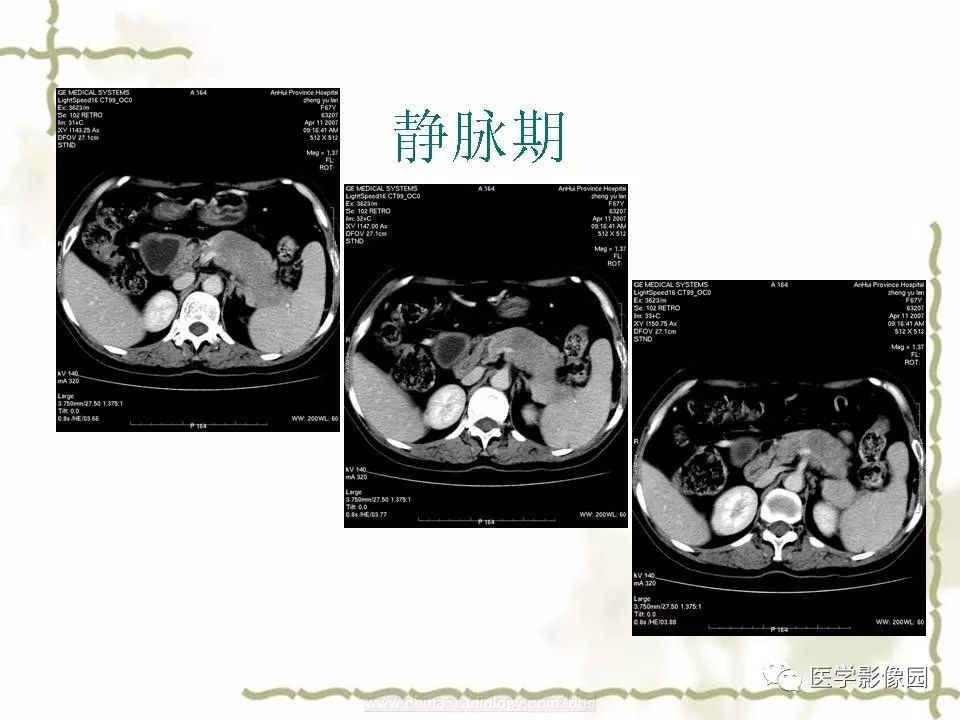 【病例】胰腺神经内分泌癌1例CT影像表现