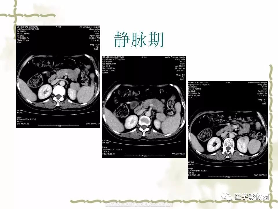 【病例】胰腺神经内分泌癌1例CT影像表现