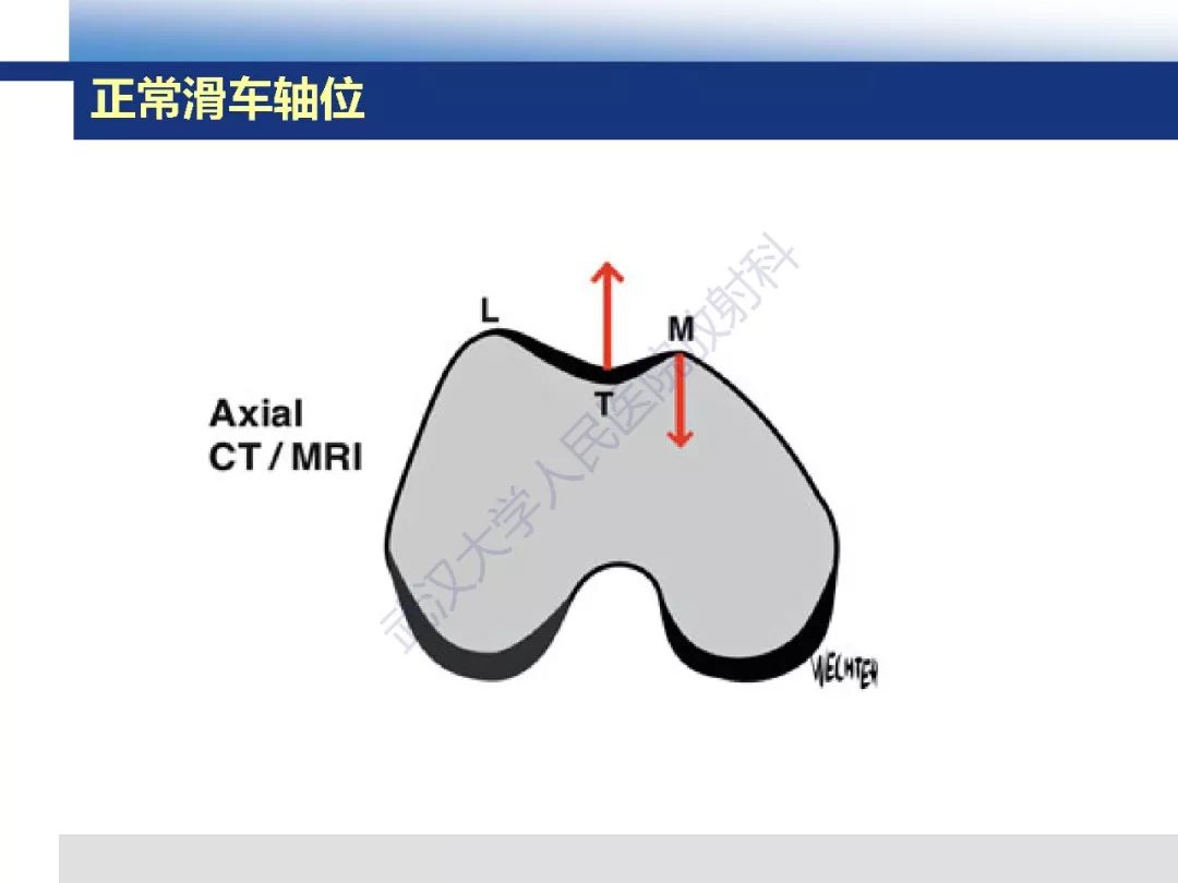 【PPT】髌骨不稳的影像学评价