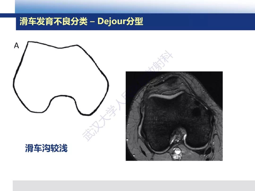 【PPT】髌骨不稳的影像学评价