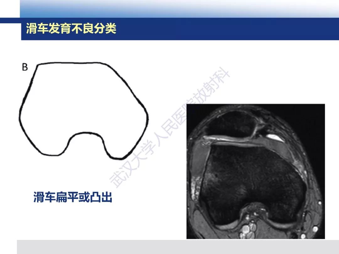 【PPT】髌骨不稳的影像学评价